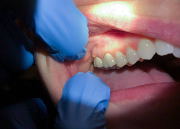 Best Emergency Denture Repair in Esko, MN